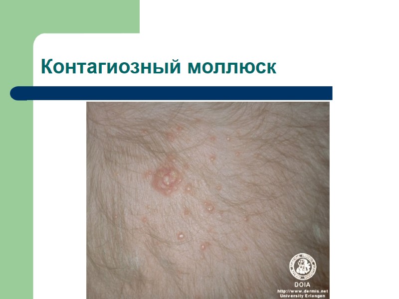 Контагиозный моллюск